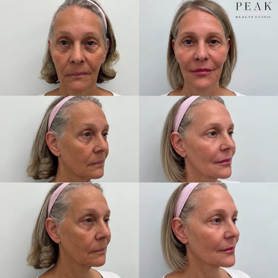 Before and after, Peak Beauty patient 2, every angle