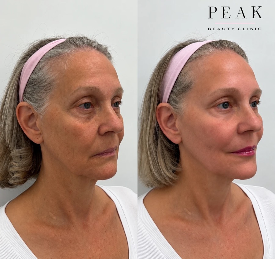 Before and after, Peak Beauty patient 2, angled view