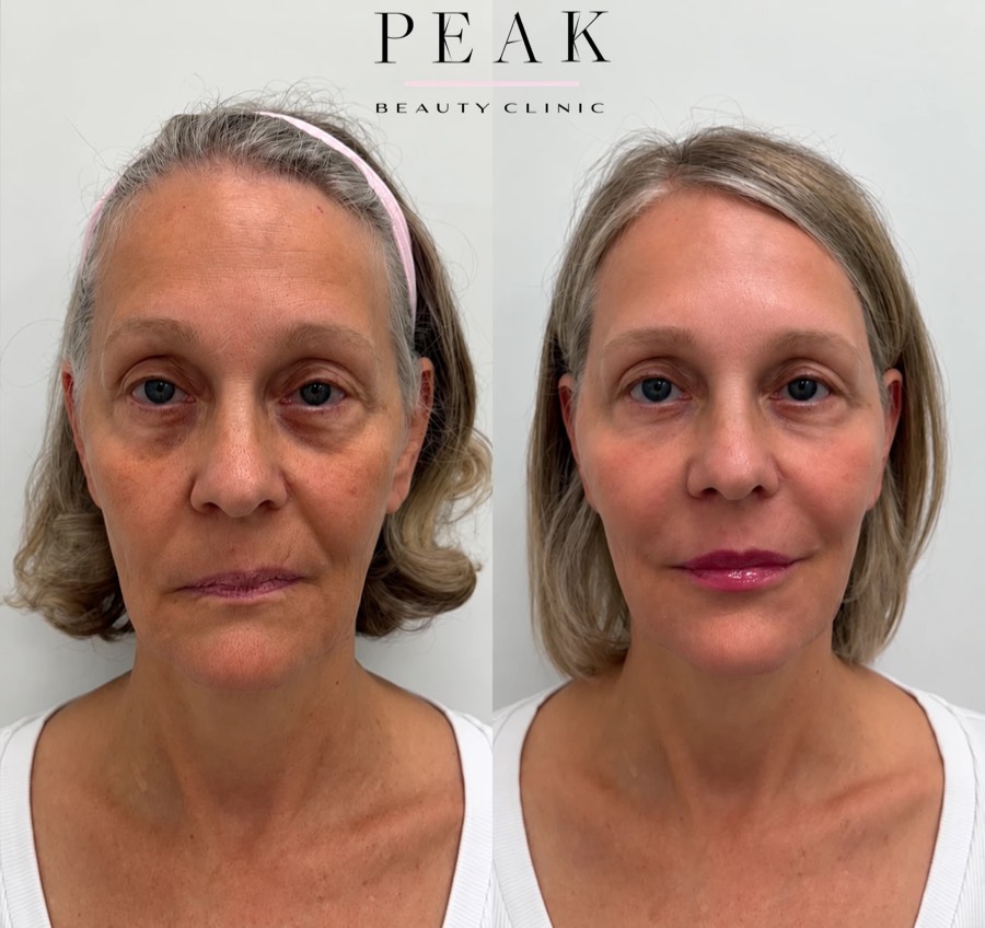 Before and after, Peak Beauty patient 2, front view