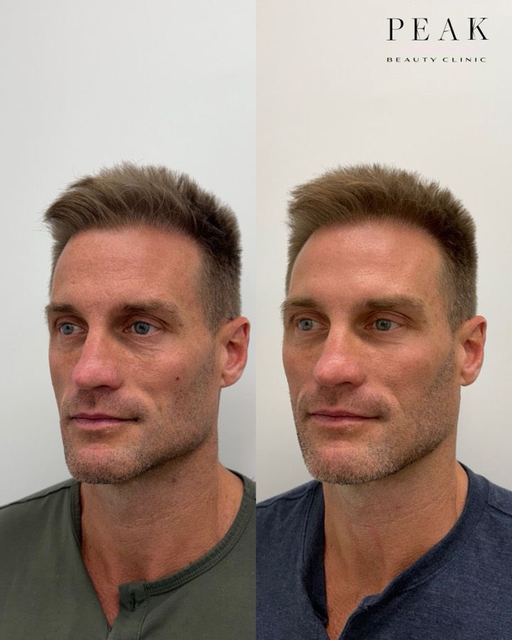 Before and after, Peak Beauty patient 36, angled view