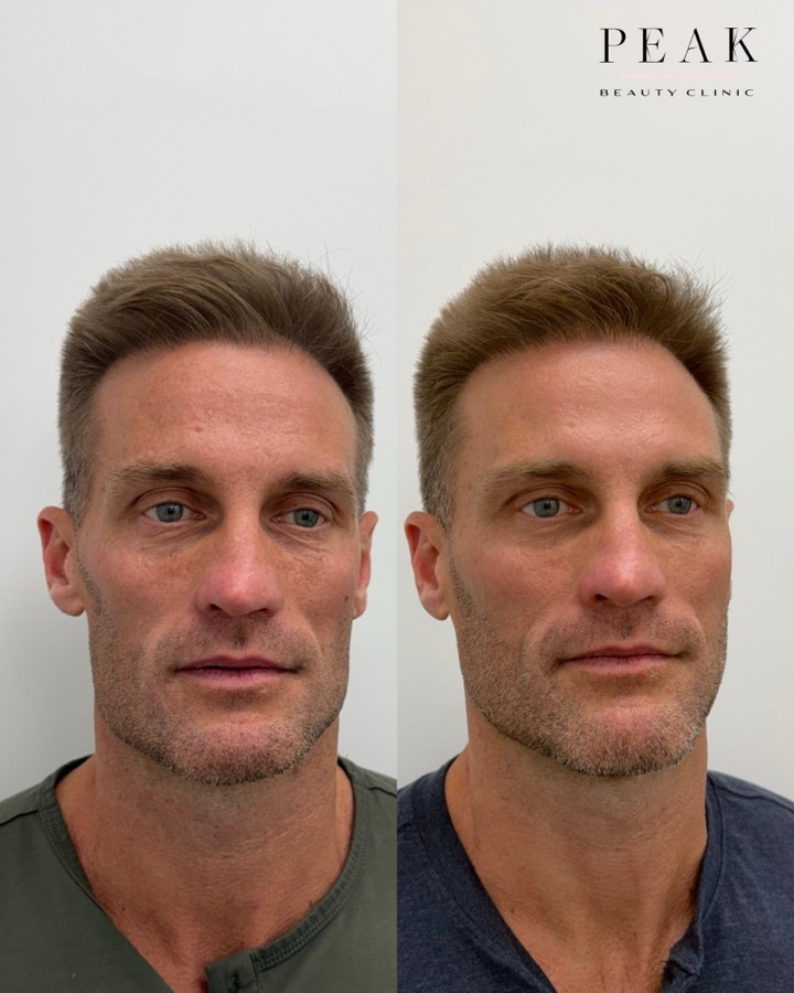 Before and after, Peak Beauty patient 36, front view