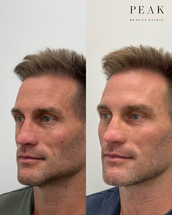 Before and after, Peak Beauty patient 36, profile