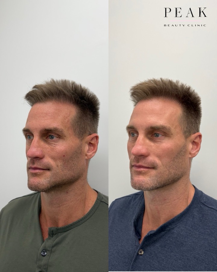 Before and after, Peak Beauty patient 36, side view