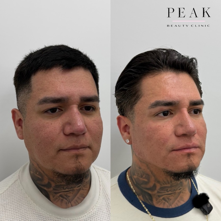Before and after, Peak Beauty patient 35, angled view