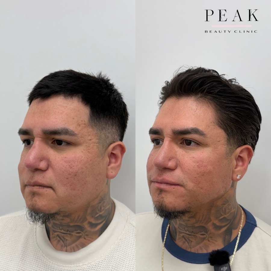 Before and after, Peak Beauty patient 35, other side