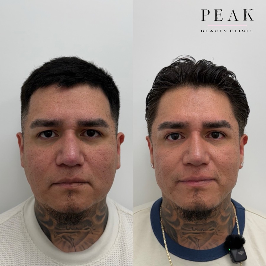 Before and after, Peak Beauty patient 35, front view