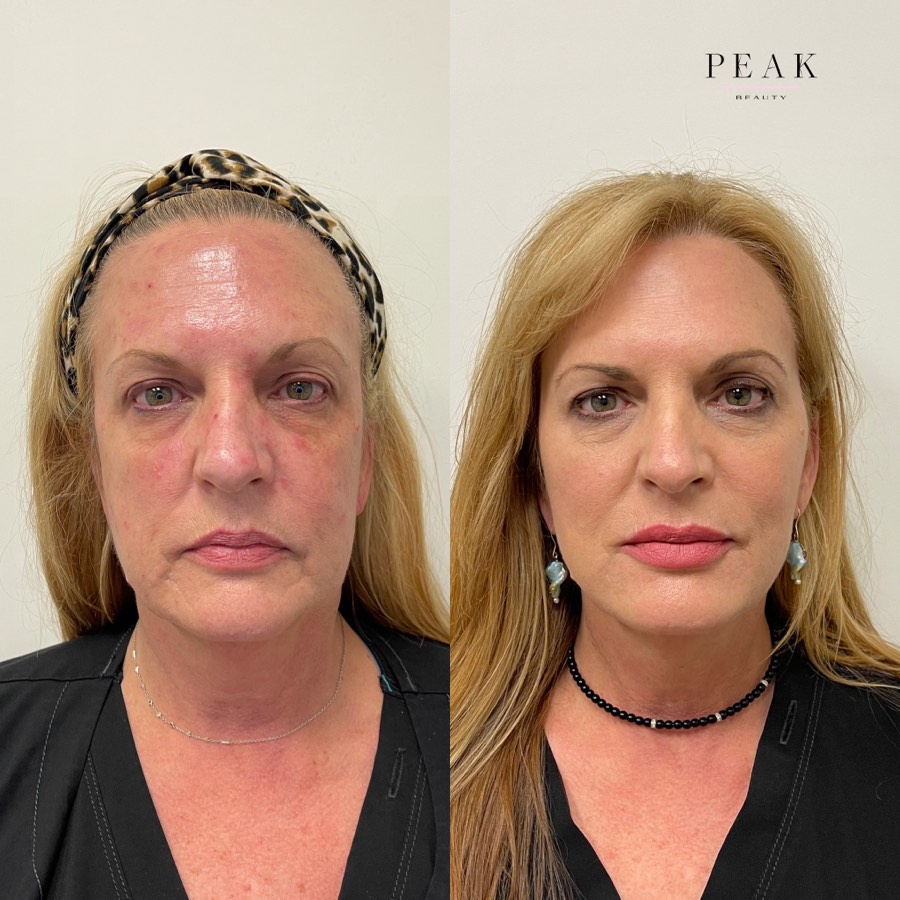Before and after, Peak Beauty patient 3, front view