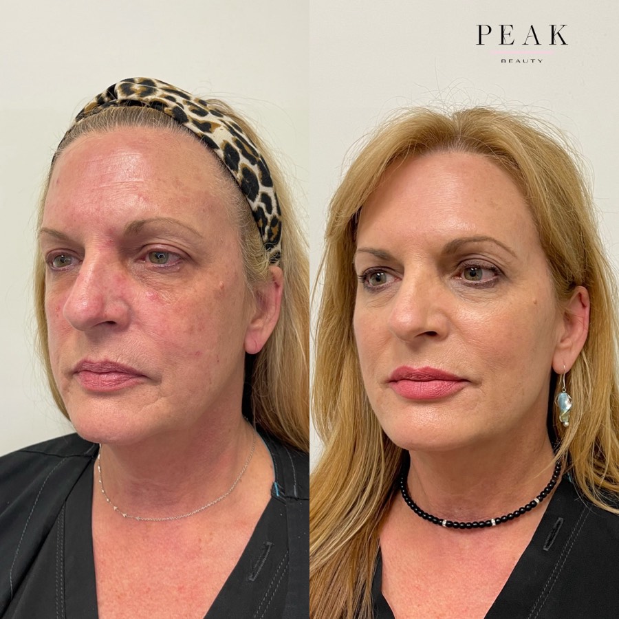 Before and after, Peak Beauty patient 3, angled view