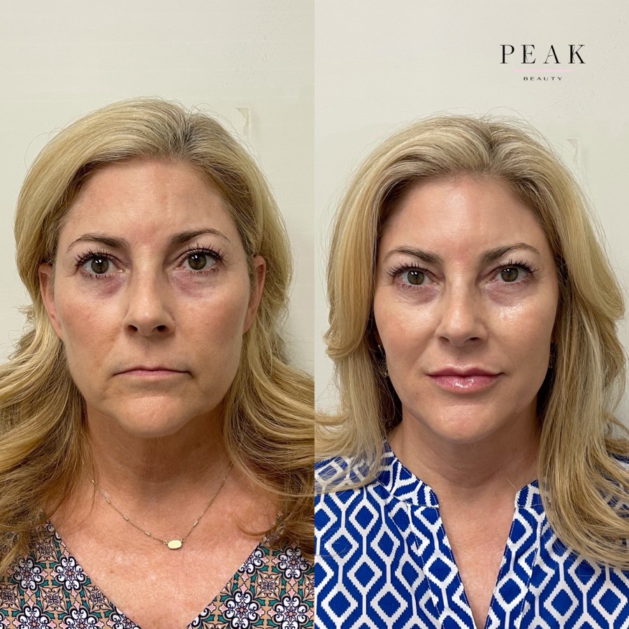 Before and after, Peak Beauty patient 4, front view