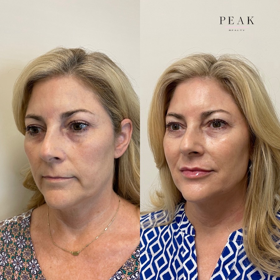 Before and after, Peak Beauty patient 4, angled view