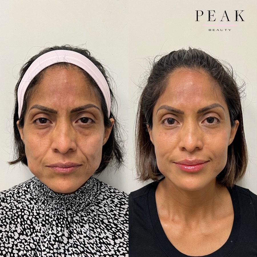 Before and after, Peak Beauty patient 15, front view