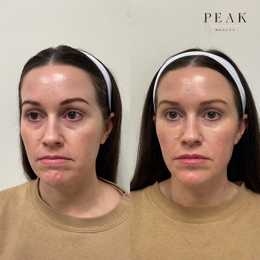Before and after, Peak Beauty patient 20, front view
