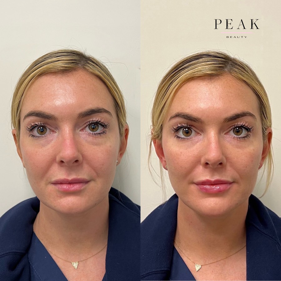 Before and after, Peak Beauty patient 30, front view