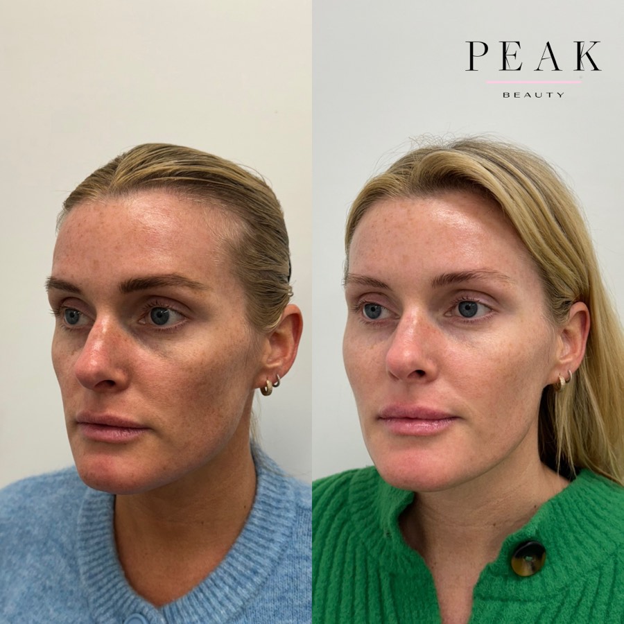 Before and after, Peak Beauty patient 31, angled view