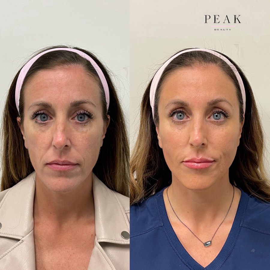 Before and after, Peak Beauty patient 16, front view