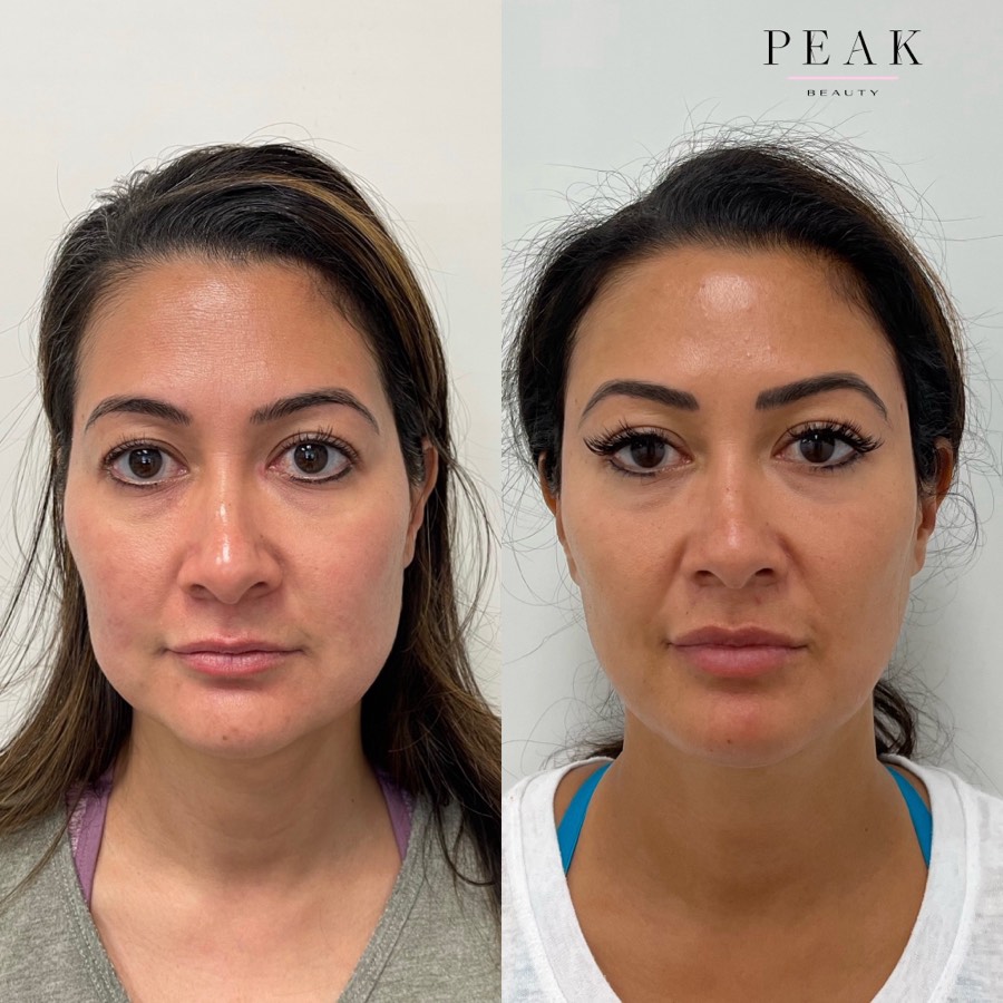 Before and after, Peak Beauty patient 28, front view