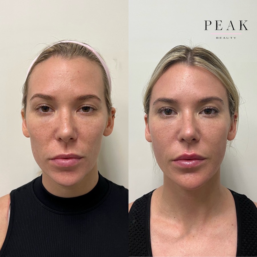 Before and after, Peak Beauty patient 29, front view