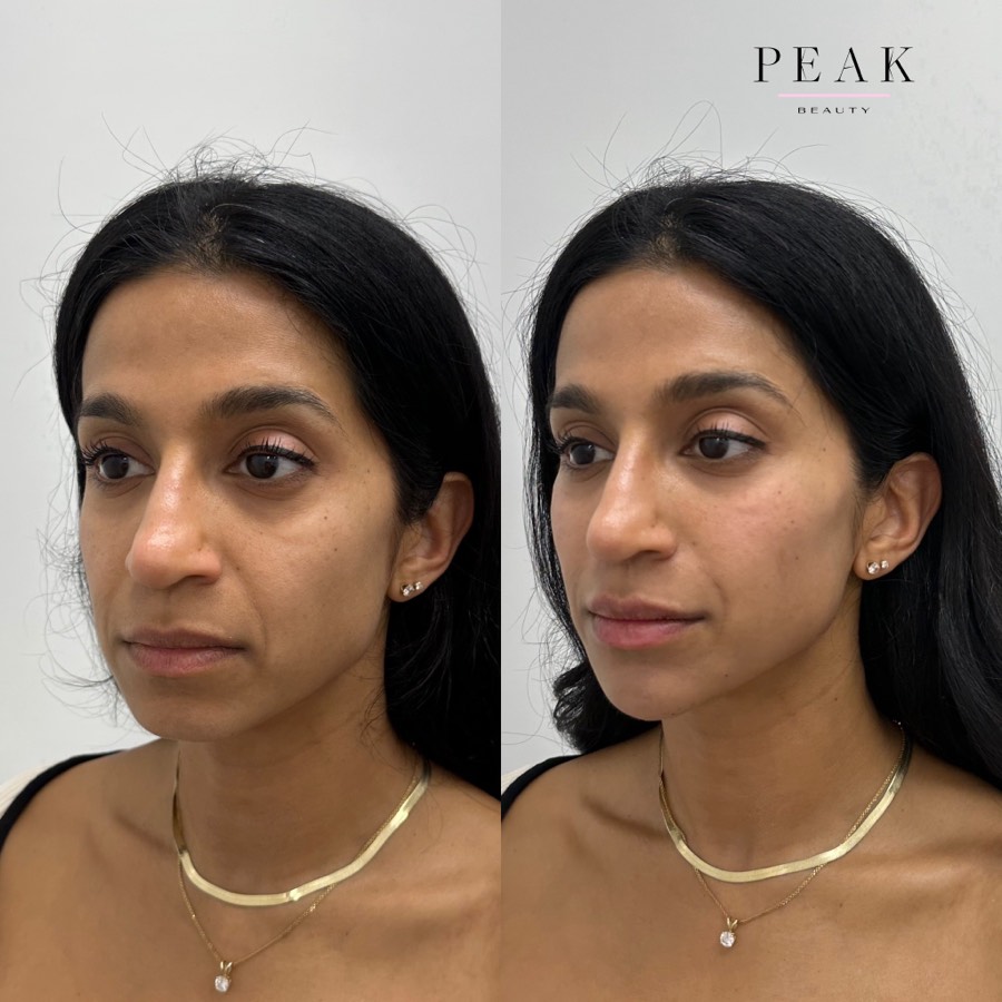 Before and after, Peak Beauty patient 27, angled view