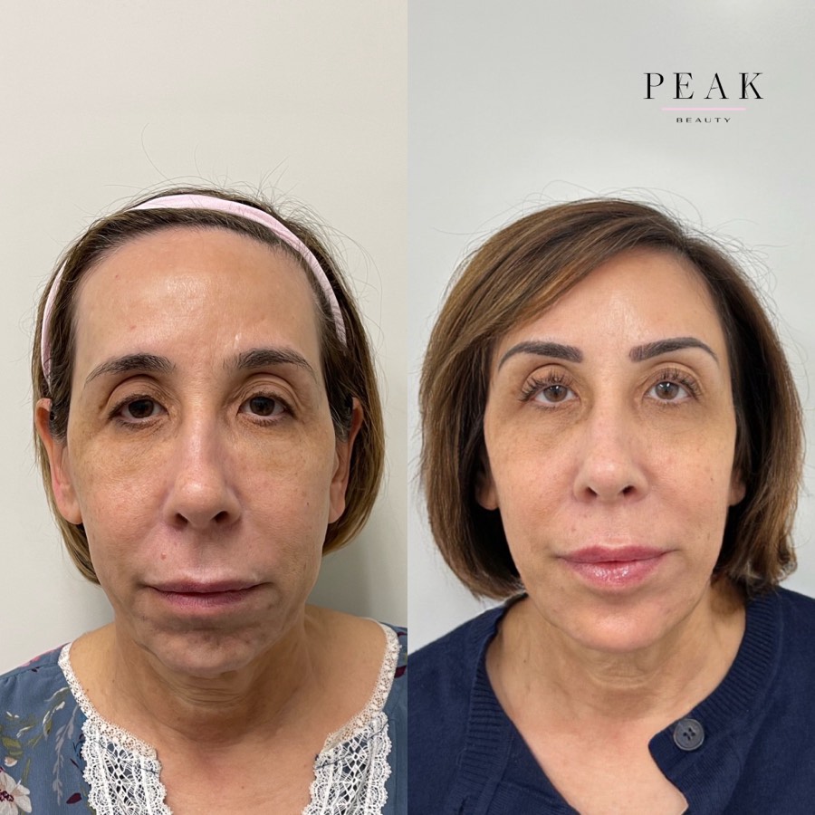 Before and after, Peak Beauty patient 8, front view