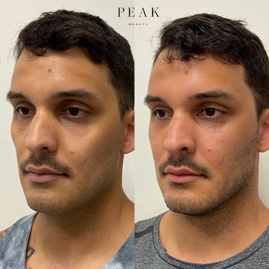 Before and after, Peak Beauty patient 39, angled view