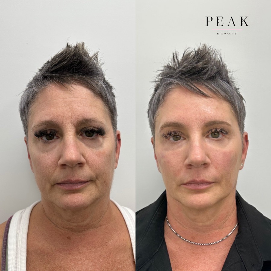 Before and after, Peak Beauty patient 10, front view