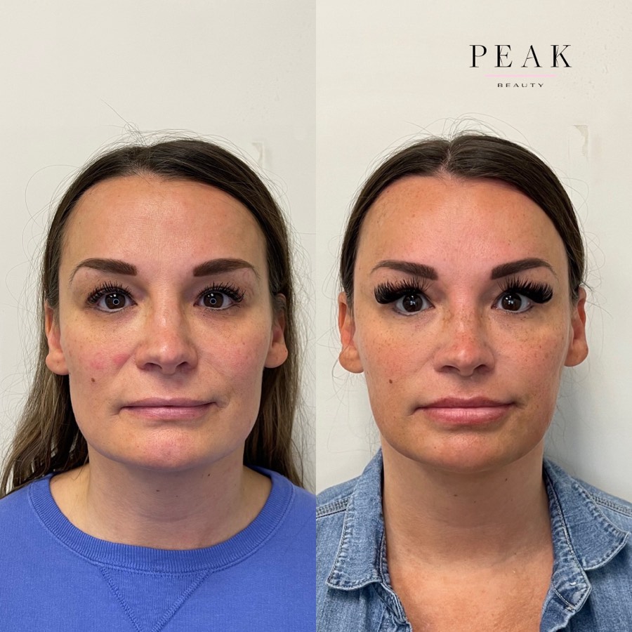 Before and after, Peak Beauty patient 24, front view