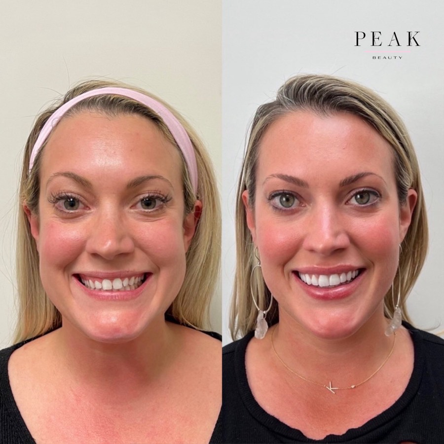 Before and after, Peak Beauty patient 32, front view