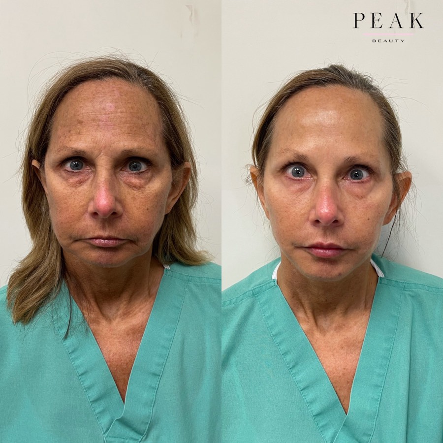 Before and after, Peak Beauty patient 7, front view