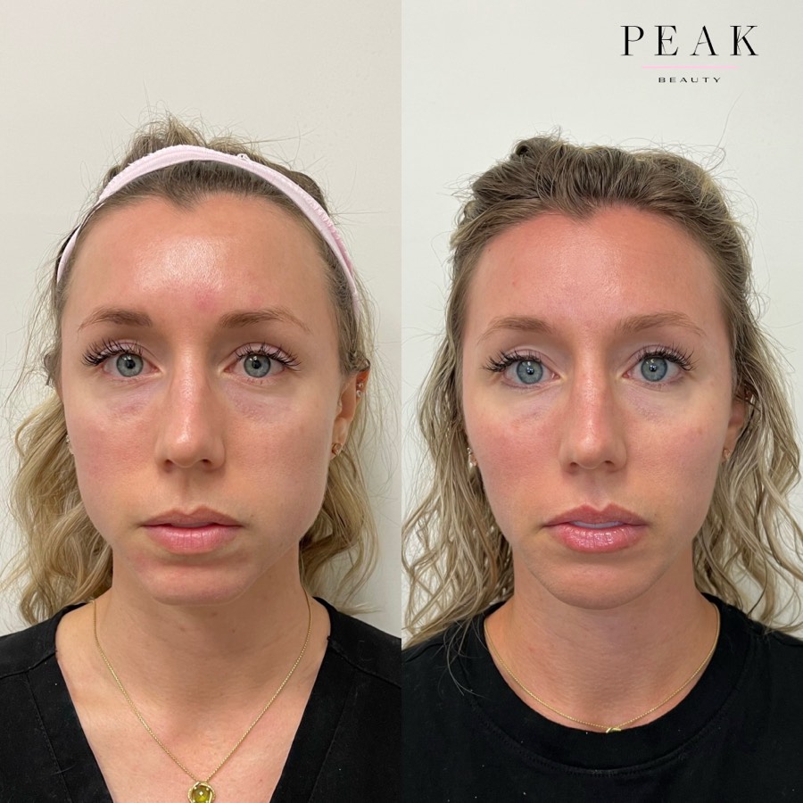 Before and after, Peak Beauty patient 23, front view