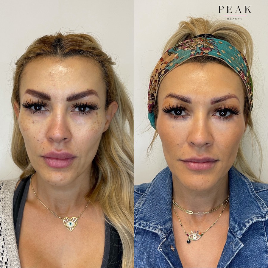 Before and after, Peak Beauty patient 12, front view