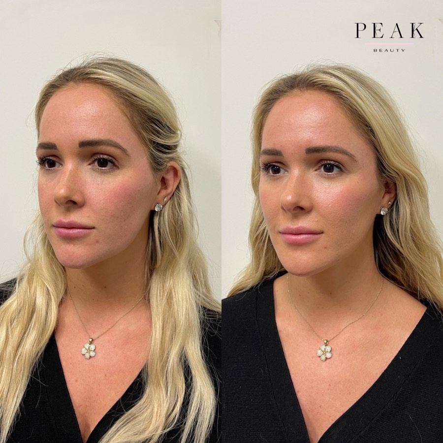 Before and after, Peak Beauty patient 19, angled view
