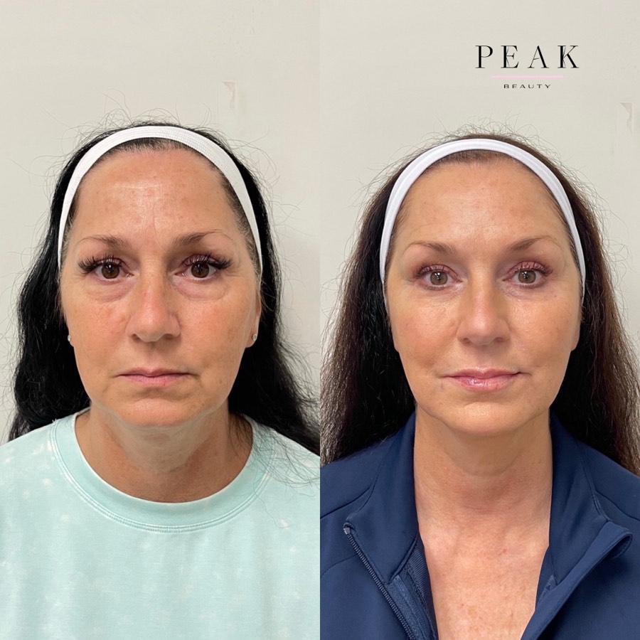 Before and after, Peak Beauty patient 9, front view
