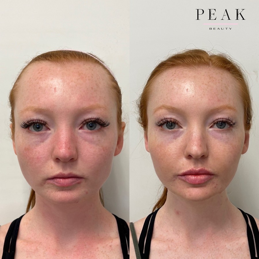 Before and after, Peak Beauty patient 34, front view