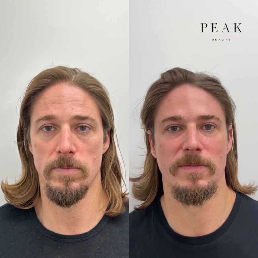 Before and after, Peak Beauty patient 37, front view