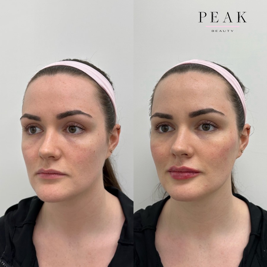 Before and after, Peak Beauty patient 18, angled view