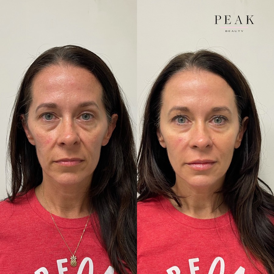 Before and after, Peak Beauty patient 5, front view