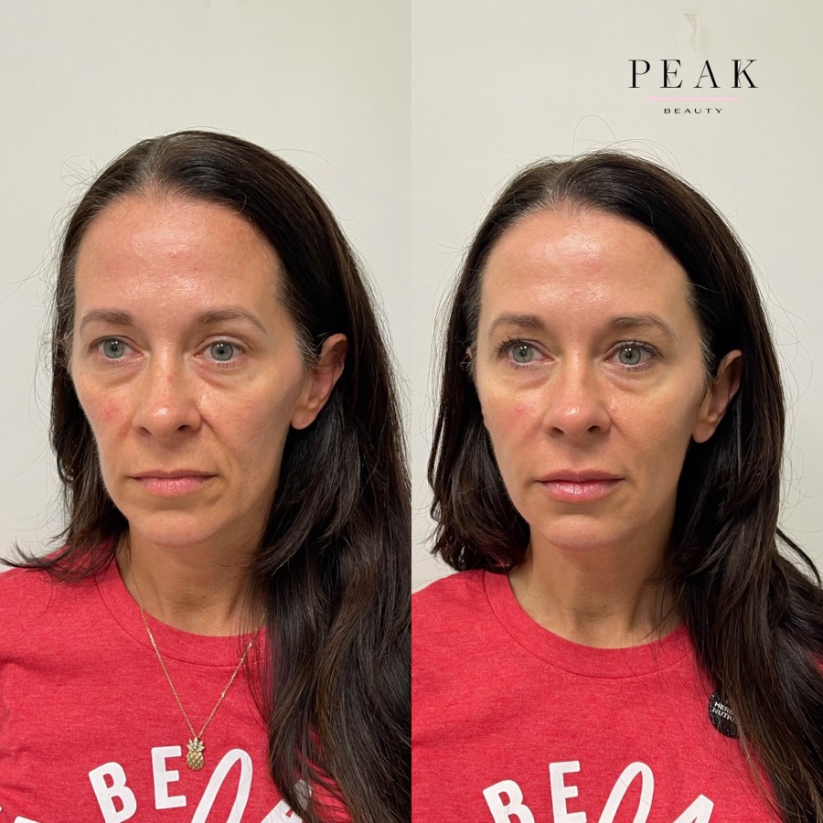 Before and after, Peak Beauty patient 5, angled view