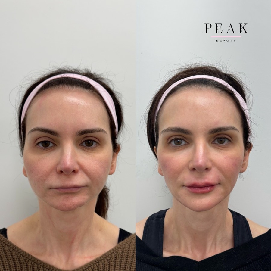 Before and after, Peak Beauty patient 14, front view