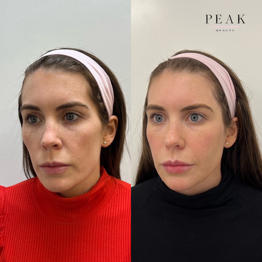 Before and after, Peak Beauty patient 33, angled view