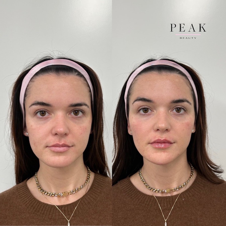 Before and after, Peak Beauty patient 17, front view