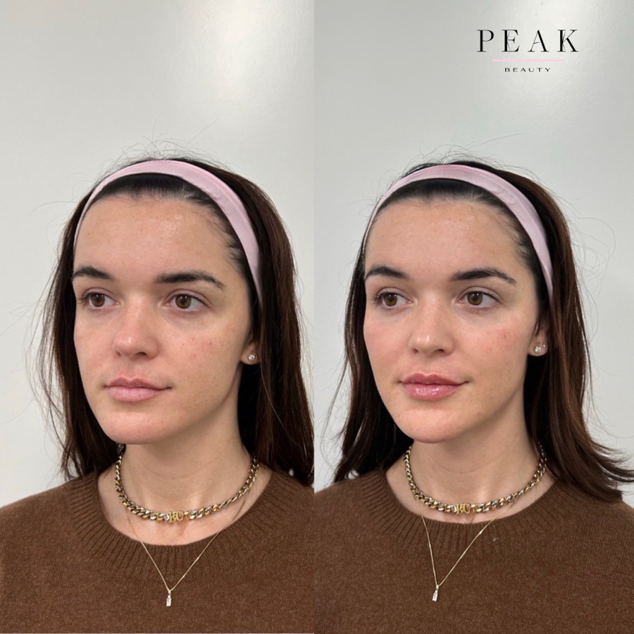 Before and after, Peak Beauty patient 17, angled view