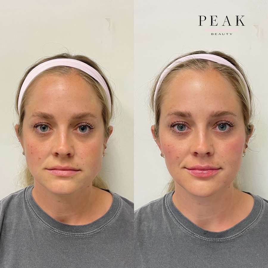 Before and after, Peak Beauty patient 21, front view