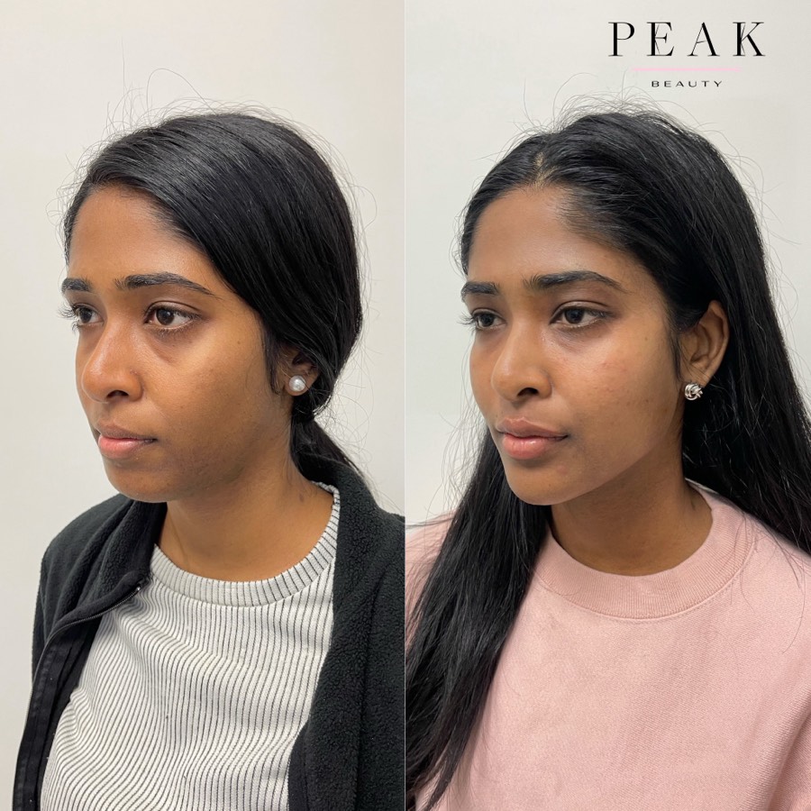Before and after, Peak Beauty patient 26, angled view