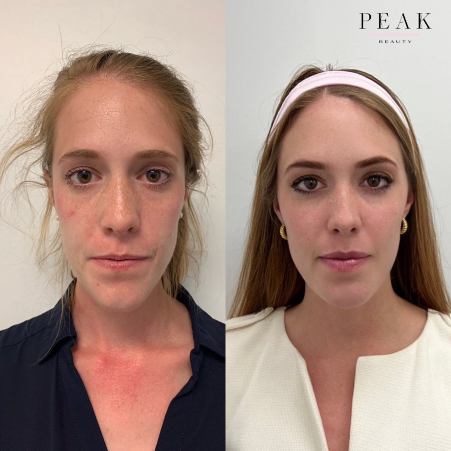 Before and after, Peak Beauty patient 22, front view