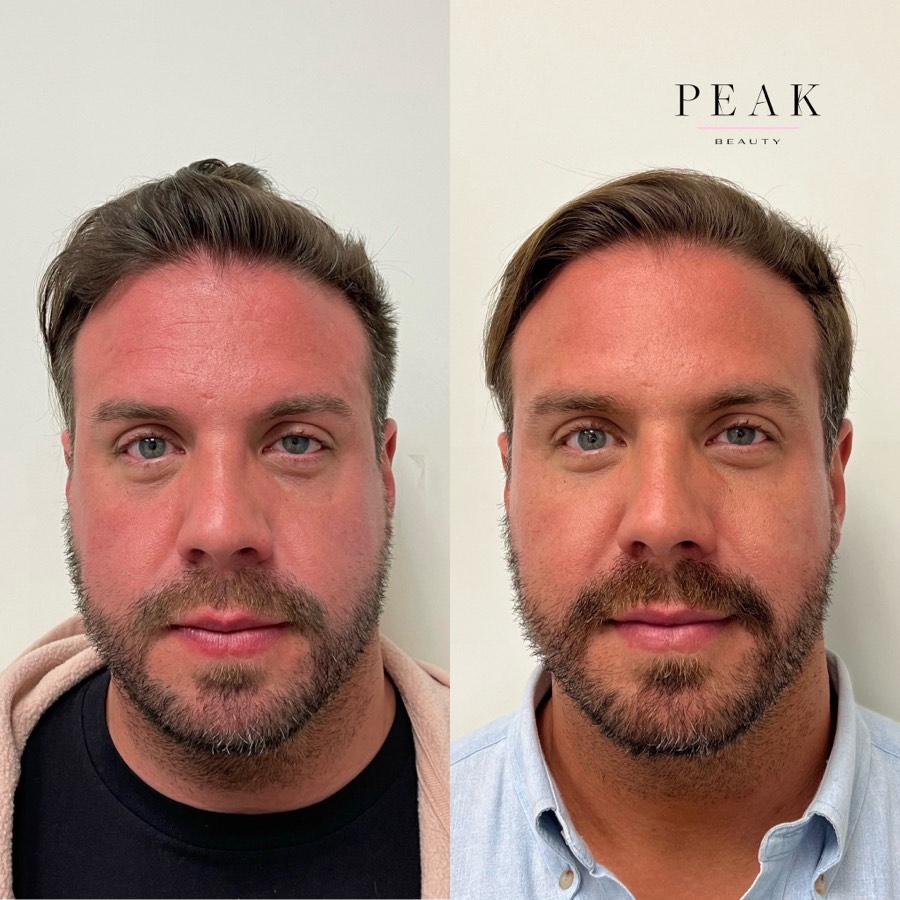 Before and after, Peak Beauty patient 38, front view