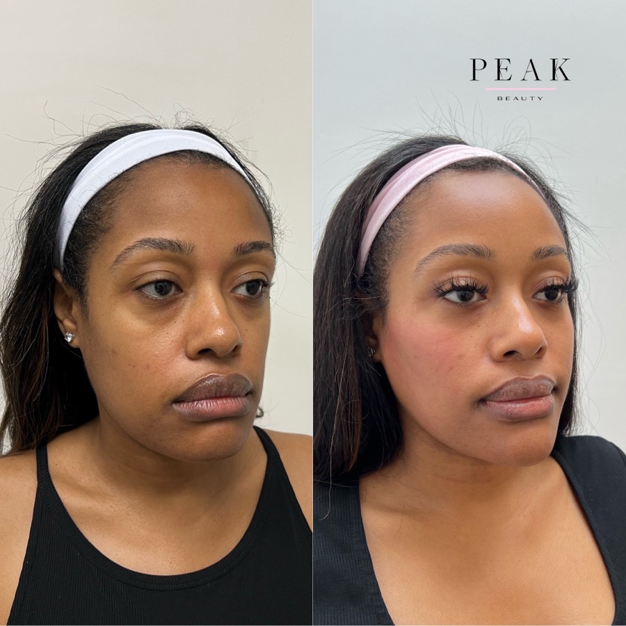 Before and after, Peak Beauty patient 25, angled view