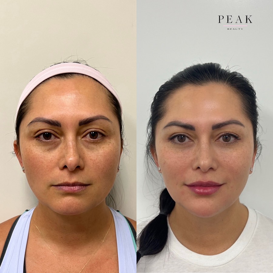 Before and after, Peak Beauty patient 11, front view