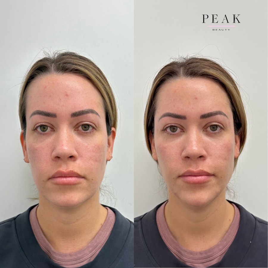 Before and after, Peak Beauty patient 13, front view