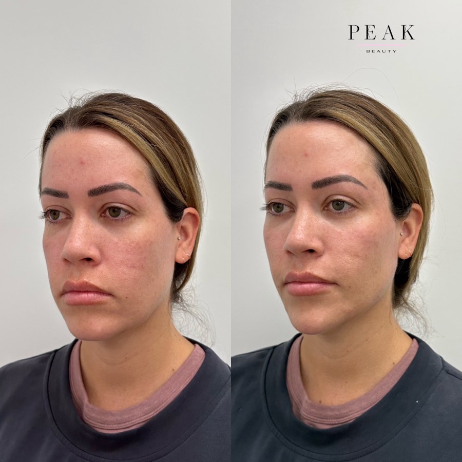 Before and after, Peak Beauty patient 13, angled view