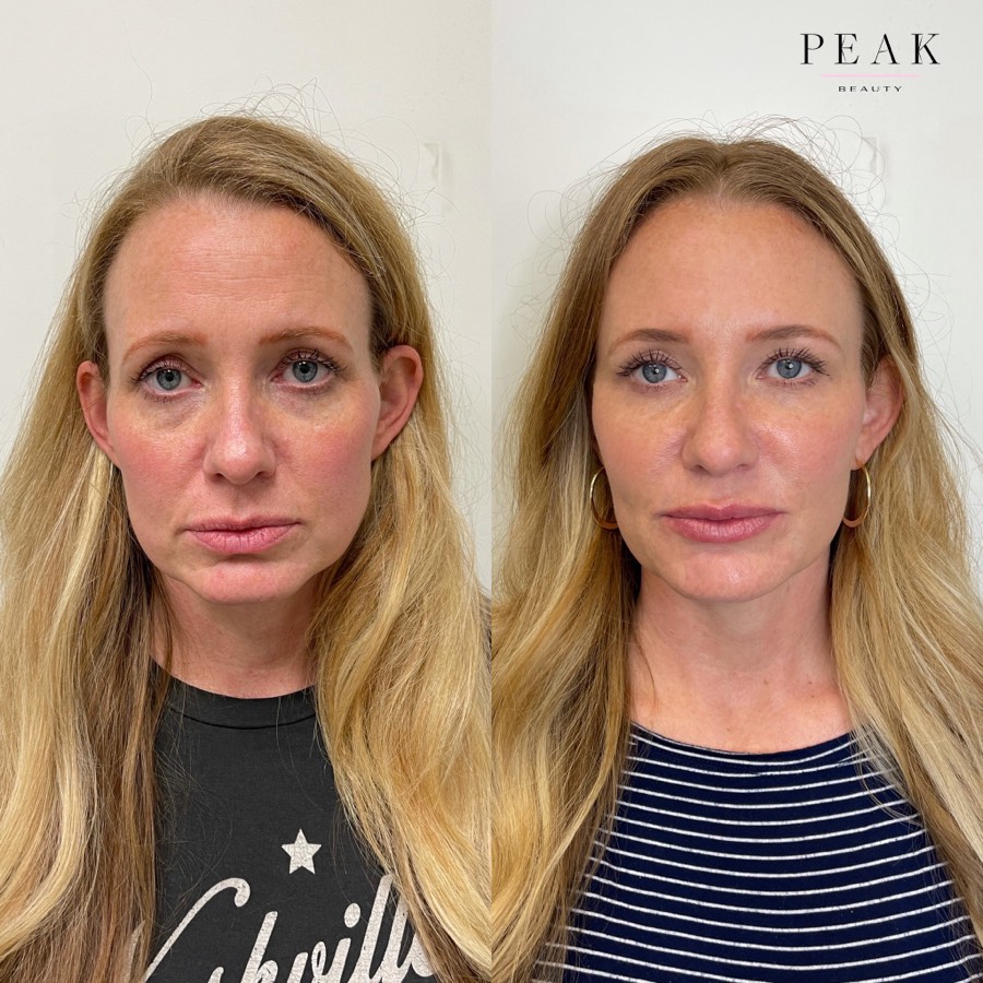 Before and after, Peak Beauty patient 6, front view